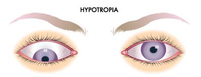 Hypotropia